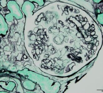 Image histologique d’un rejet de greffe rénale médié par des anticorps