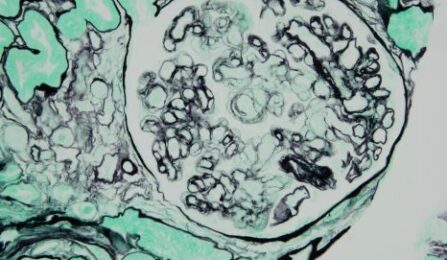 Image histologique d’un rejet de greffe rénale médié par des anticorps
